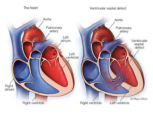 "diagram showing normal heart and ventricular septal defect illustrating hole between left and right ventricles